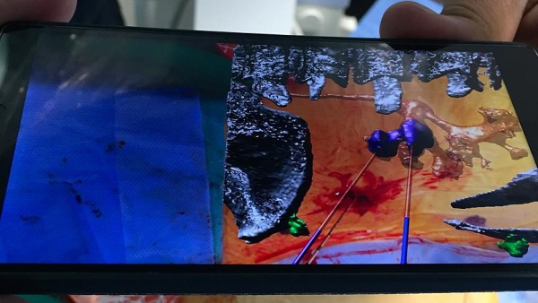 Böbrek ameliyatı 'cep'ten görüntülenerek yapılıyor