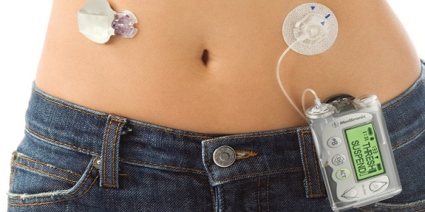 Yapay Pankreas Tip 1 Diyabet Hastalarına Çare Olabilir