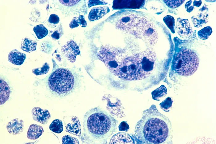 lymphoma-tumor-cells