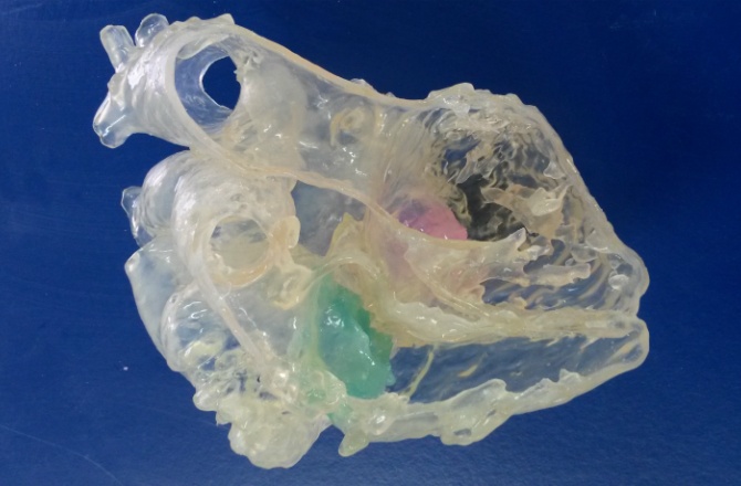 Hasta Kalbinin 3D Modeli Üretildi